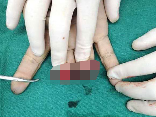 手足外科（断肢再植） - 玉环骨伤医院[官网],台州玉环,中医骨伤科,创伤 